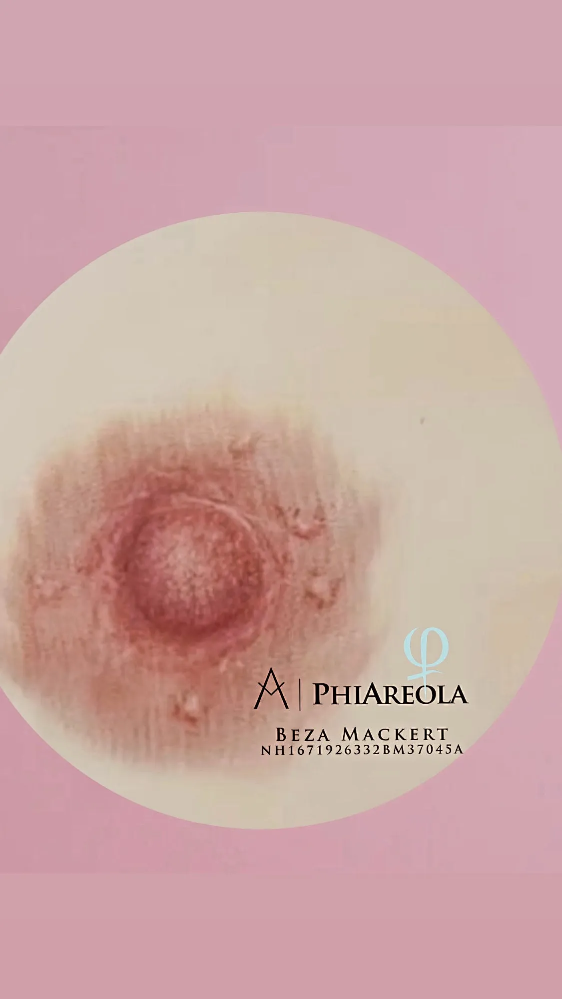 Areola Rekonstruktion: Behandlungsbeispiel 1