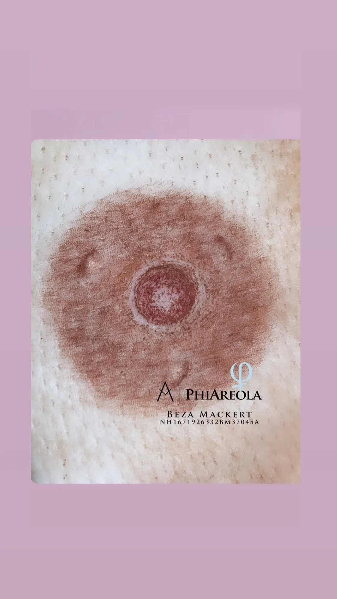 Areola Rekonstruktion: Behandlungsbeispiel 3