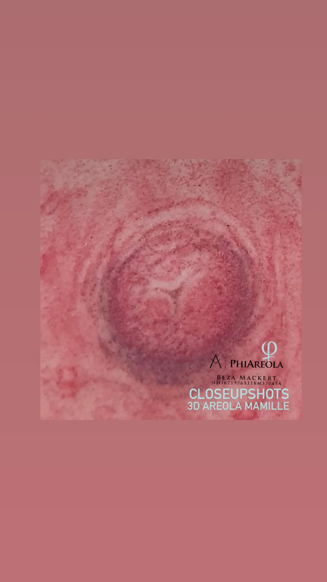 Areola Rekonstruktion: Behandlungsbeispiel 4