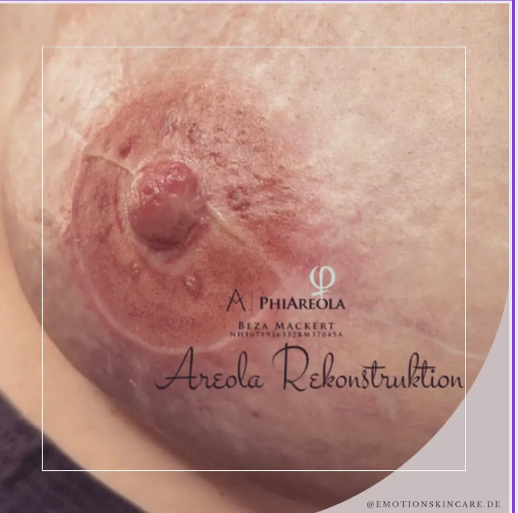 Areola Rekonstruktion: Behandlungsbeispiel 6