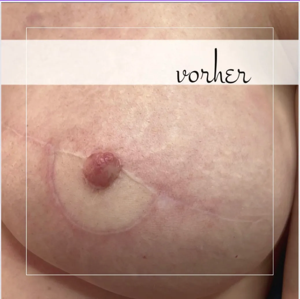 Areola Rekonstruktion: Behandlungsbeispiel 5